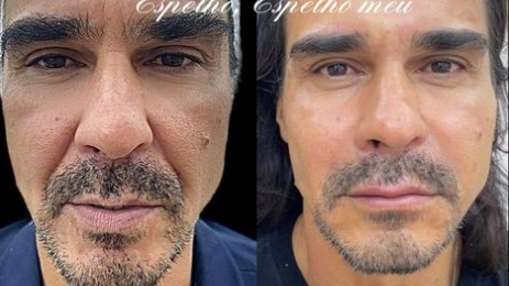 André Gonçalves aposta em harmonização facial; veja antes e depois
