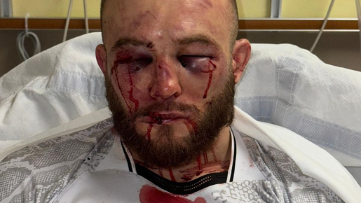 Polonês que sofreu nocaute técnico mostra estrago causado por brasileiro no UFC