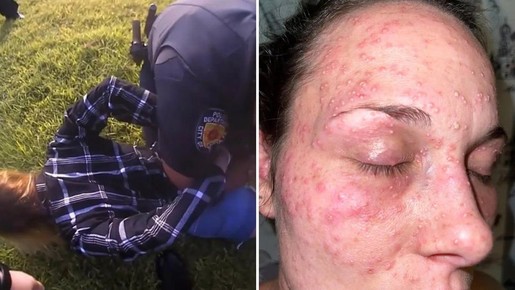Mulher processa polícia após ser algemada com a cara em formigueiro; veja fotos
