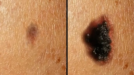 Vídeo feito com IA mostra como uma pequena mancha se transforma em câncer de pele; veja