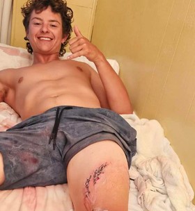 'Tive sorte': jovem é mordido após escorregar e cair em marina infestada de tubarões