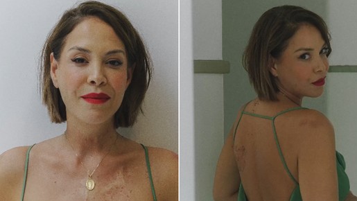 Filha de Manoel Carlos, Júlia Almeida mostra cicatrizes e fala de autoaceitação