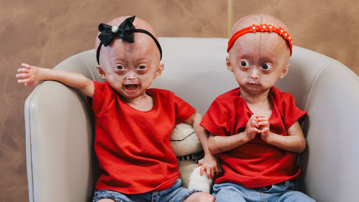 Mãe festeja os 3 anos das únicas gêmeas do mundo com síndrome da velhice precoce